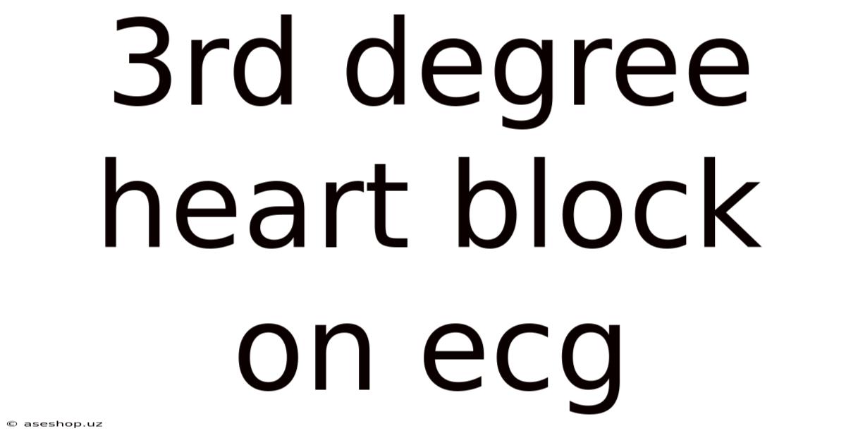 3rd Degree Heart Block On Ecg