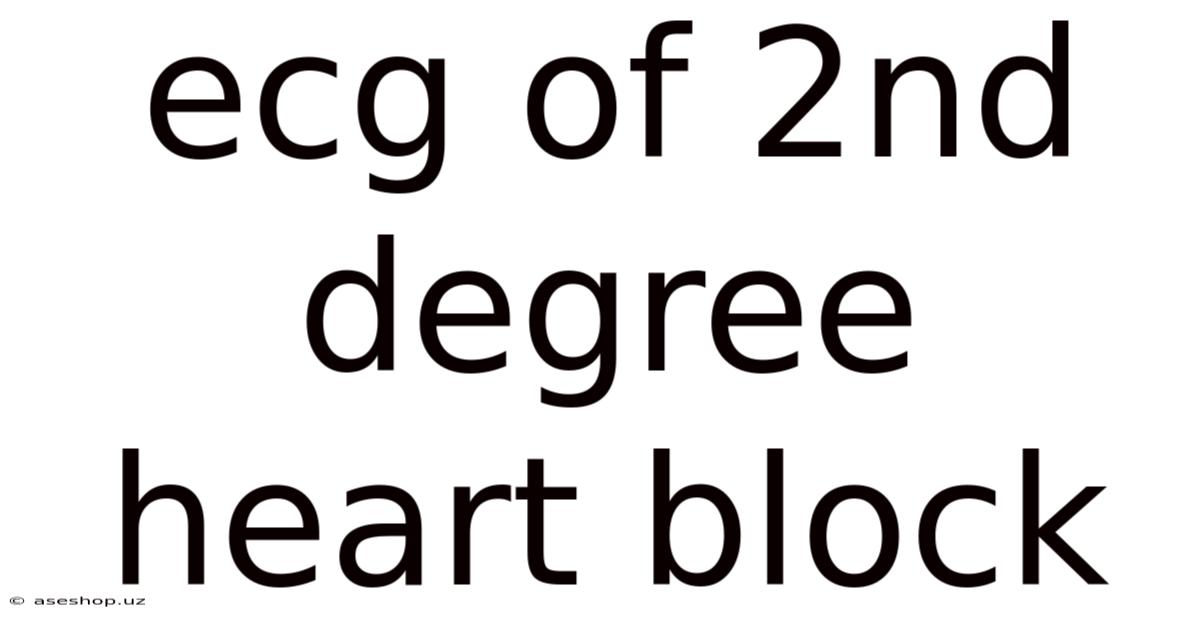 Ecg Of 2nd Degree Heart Block