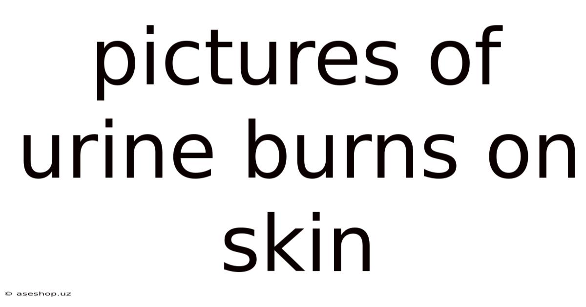 Pictures Of Urine Burns On Skin