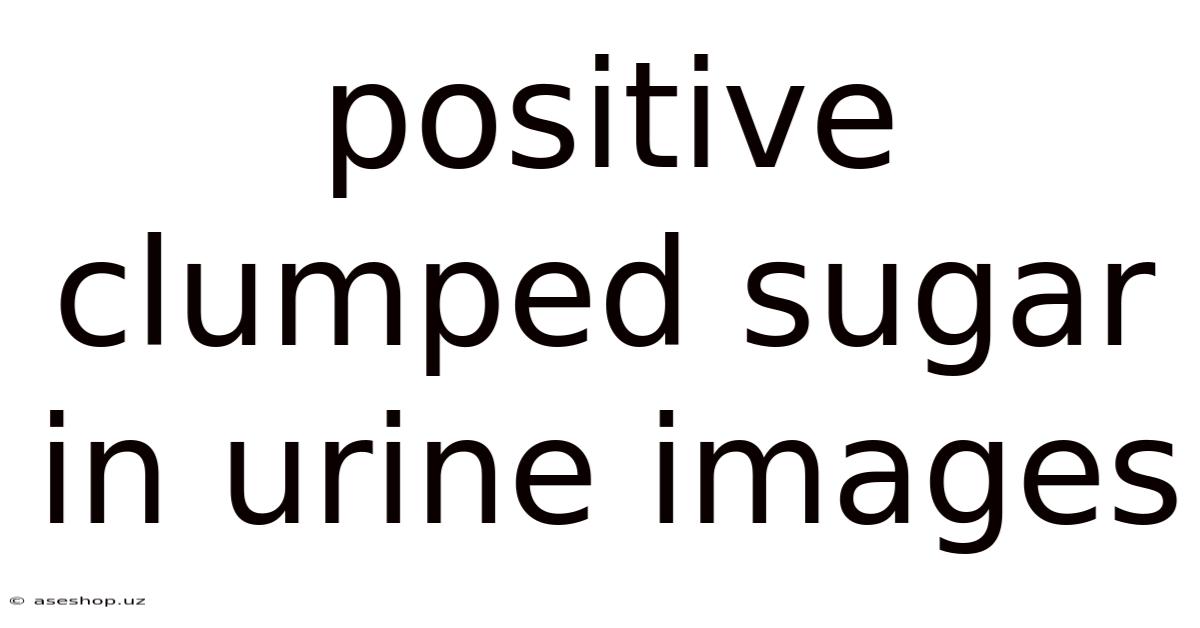 Positive Clumped Sugar In Urine Images